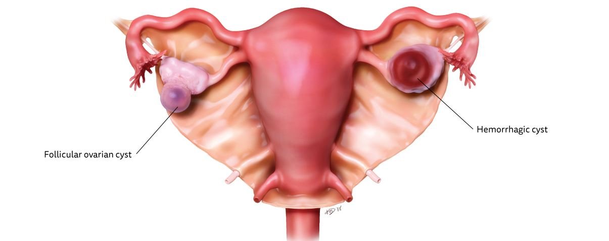 types of ovarian cysts - functional cysts
