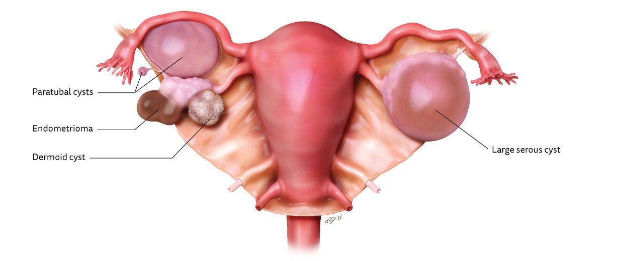 Root cause of ovarian cysts