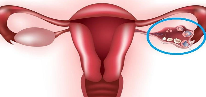 ovarian cysts and its types