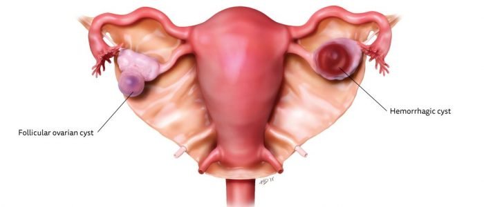 types of ovarian cysts - functional cysts