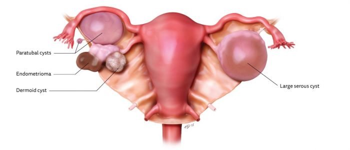 Root cause of ovarian cysts